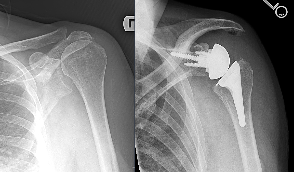 Total Shoulder Replacement (Anatomic and Reverse) - HSS Shoulder